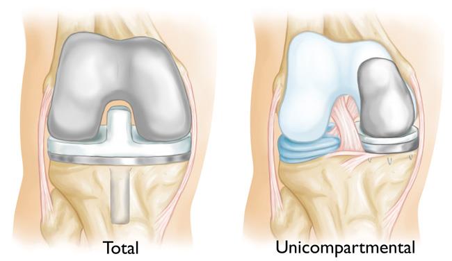 Unicompartmental Knee Replacement